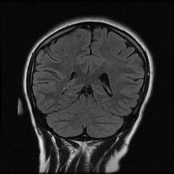 File:Cerebral cavernous malformation (Radiopaedia 44301-47942 Coronal FLAIR 18).jpg
