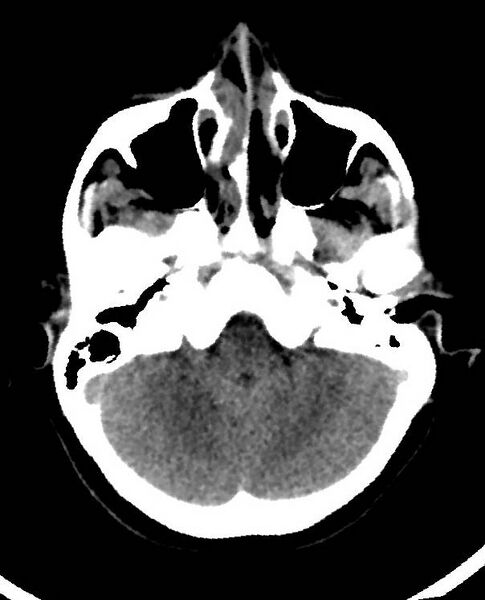 File:Cerebral edema due to severe hyponatremia (Radiopaedia 89826-106938 Axial non-contrast 23).jpg