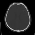 Cerebral hemorrhagic contusions (Radiopaedia 23145-23188 Axial bone window 36).jpg