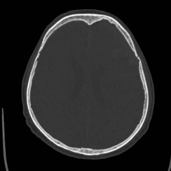 File:Cerebral hemorrhagic contusions (Radiopaedia 23145-23188 Axial bone window 36).jpg