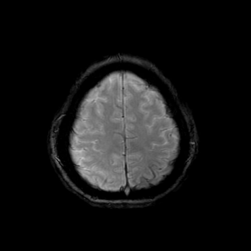 Cerebral paragonimiasis (Radiopaedia 73473-84238 Axial SWI 56).jpg