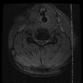 Cervical flexion teardrop fracture with cord hemorrhage (Radiopaedia 32497-33455 Axial Gradient Echo 15).jpg