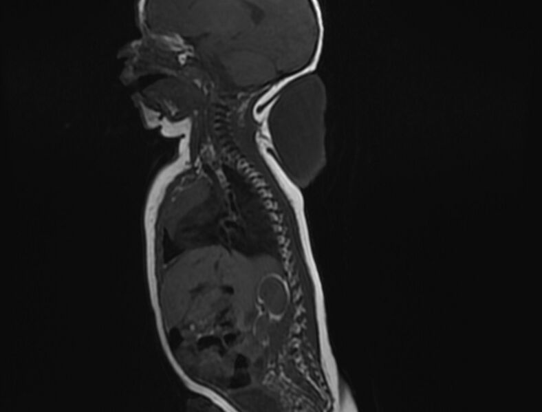 File:Cervical myelomeningocele (Radiopaedia 69569-79479 Sagittal T1 4).jpg