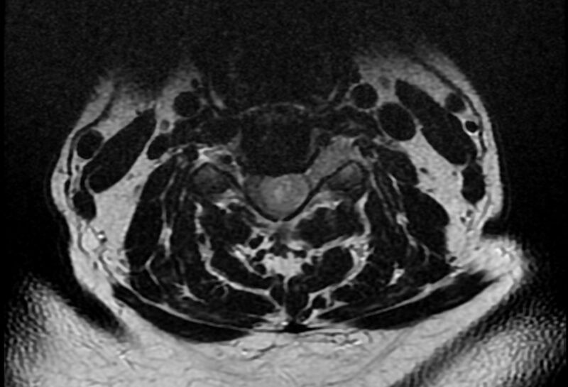 File:Cervical schwannoma (Radiopaedia 72399-82934 Axial T2 10).jpg