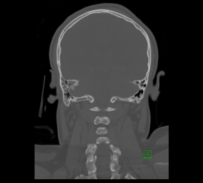 File:Cervical spine fracture - hyperflexion injury (Radiopaedia 66184-75364 Coronal bone window 11).jpg