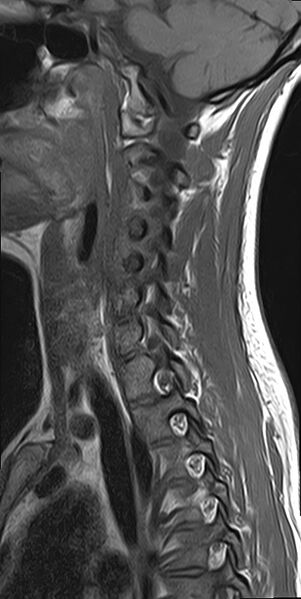 File:Cervical spondylodiscitis and calvarial hemangioma (Radiopaedia 64317-73104 Sagittal T1 4).jpg