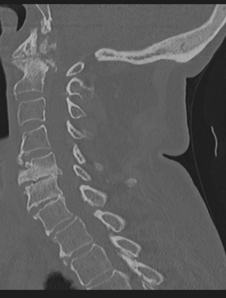 File:Cervical spondylolysis (Radiopaedia 49616-54811 Sagittal bone window 34).png