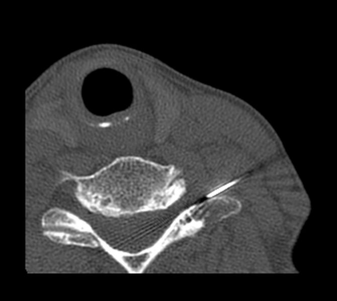 File:Cervical transforaminal epidural steroid injection (CT-guided) (Radiopaedia 75220-86318 Axial bone window 5).jpg