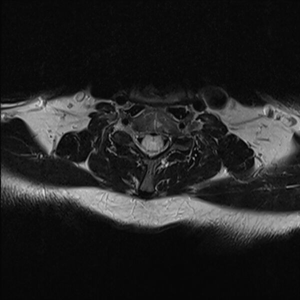File:Cervical tumor-like myelopathy due to Type V dAVF (Radiopaedia 82461-96604 Axial T2 25).jpg