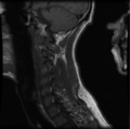 Cervical vertebrae metastasis (Radiopaedia 78814-91667 Sagittal T1 9).png