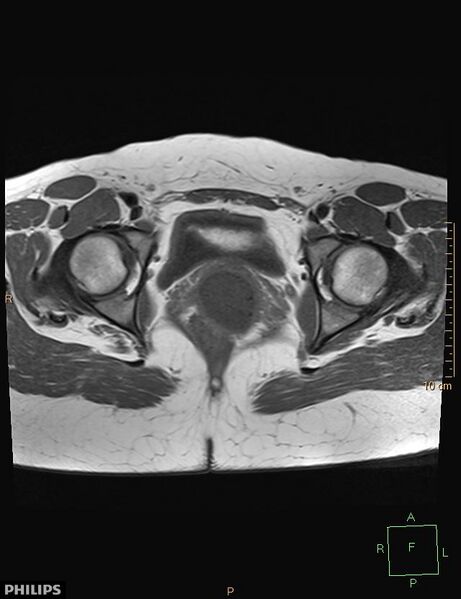 File:Cesarian scar endometriosis (Radiopaedia 68495-78066 Axial T1 19).jpg