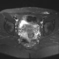 Cesarian section scar endometriosis (Radiopaedia 66520-75799 Axial T2 fat sat 15).jpg