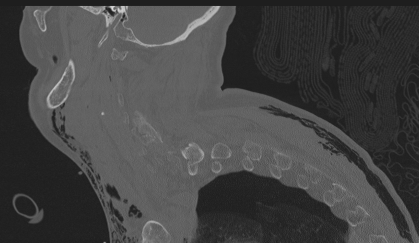 Chalk stick fracture (Radiopaedia 57948-64928 Sagittal bone window 11).png