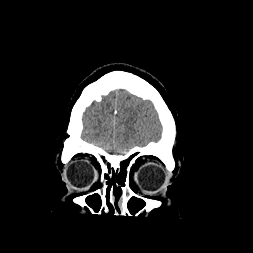 Chiasmatic-hypothalamic juvenile pilocytic astrocytoma (Radiopaedia 78533-91237 Coronal non-contrast 12).jpg