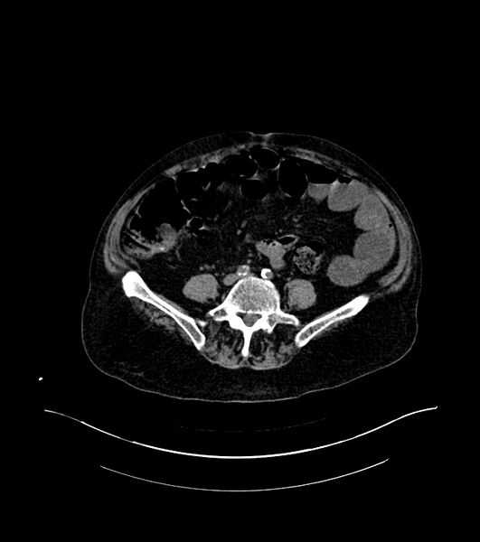 File:Cholangiocarcinoma with cerebral metastases (Radiopaedia 83519-98629 Axial non-contrast 80).jpg