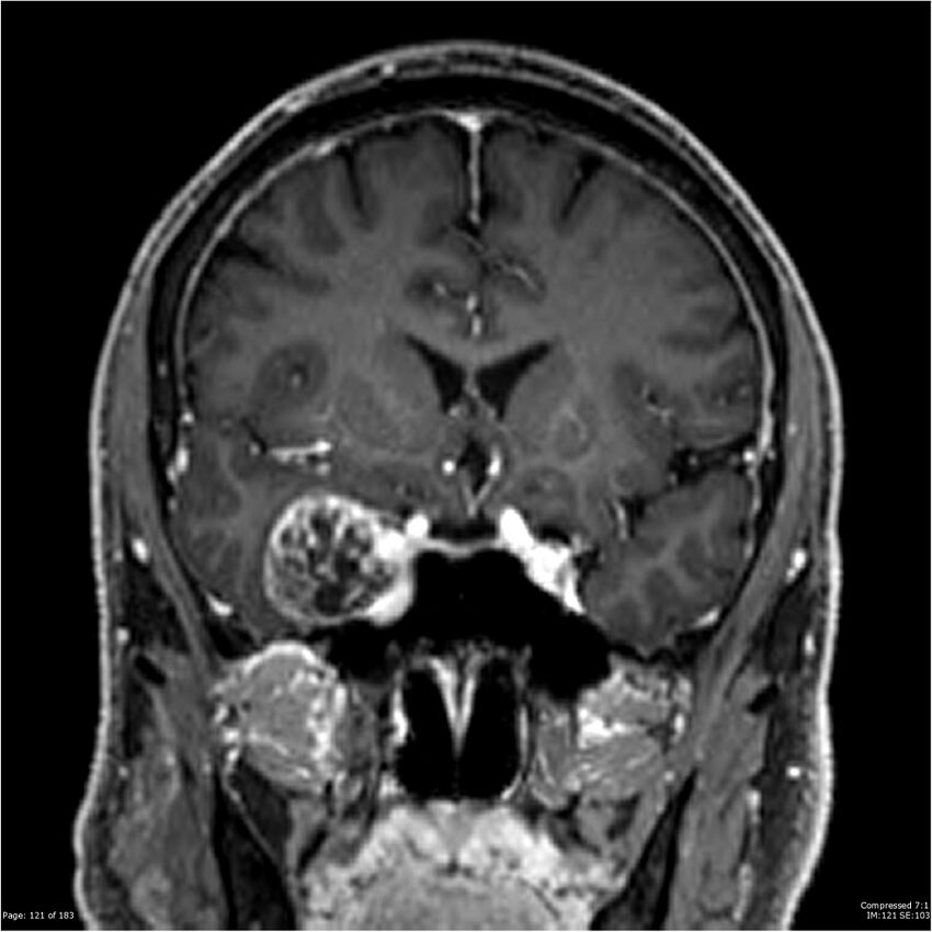 Chondrosarcoma of skull base- grade II (Radiopaedia 40948-43654 Coronal T1 C+ 32).jpg