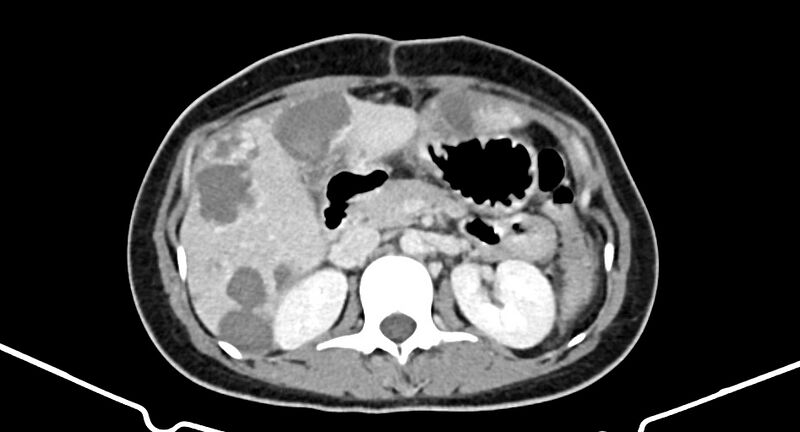 File:Choriocarcinoma liver metastases (Radiopaedia 74768-85766 A 85).jpg