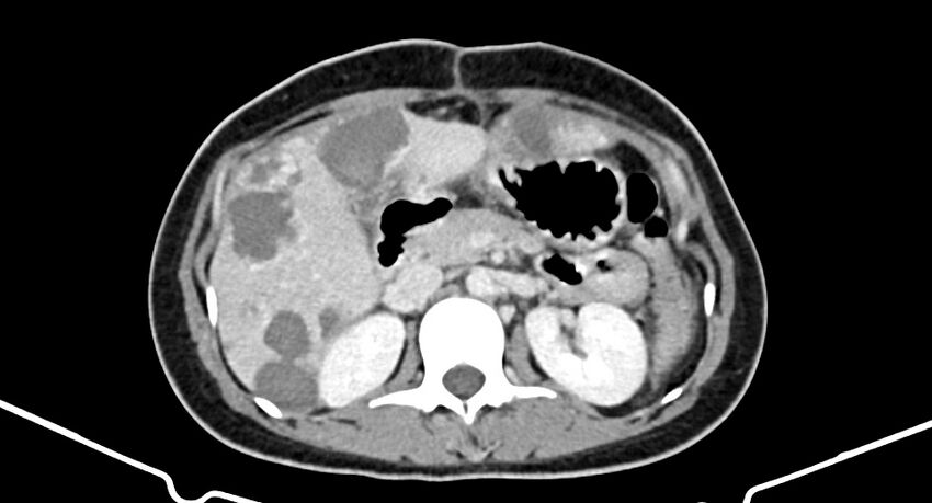 Choriocarcinoma liver metastases (Radiopaedia 74768-85766 A 85).jpg