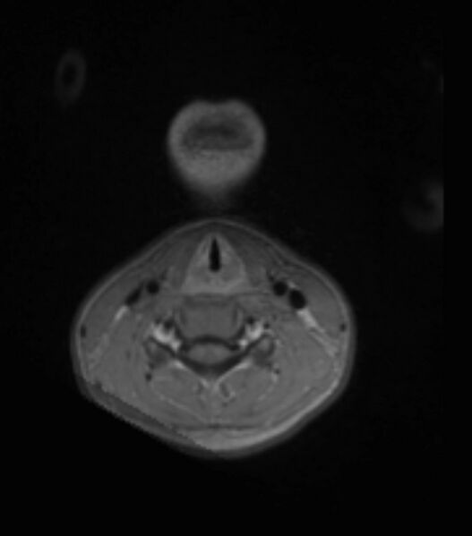 File:Choroid plexus carcinoma (Radiopaedia 91013-108553 Axial T1 C+ 3).jpg
