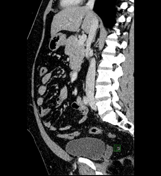 File:Chromophobe renal cell carcinoma (Radiopaedia 84286-99573 I 101).jpg