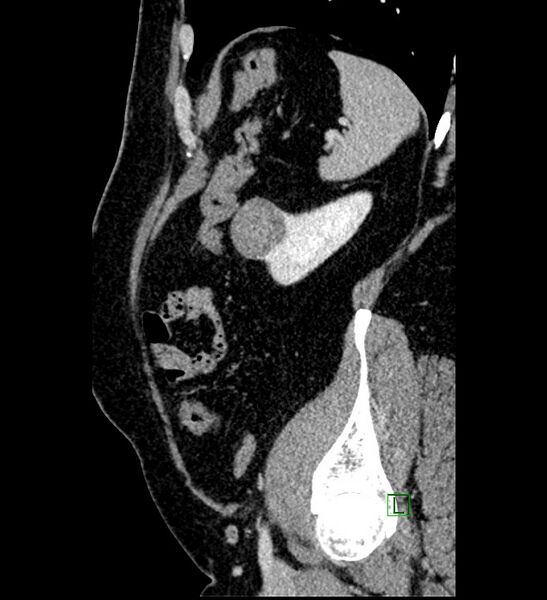 File:Chromophobe renal cell carcinoma (Radiopaedia 84286-99573 I 36).jpg