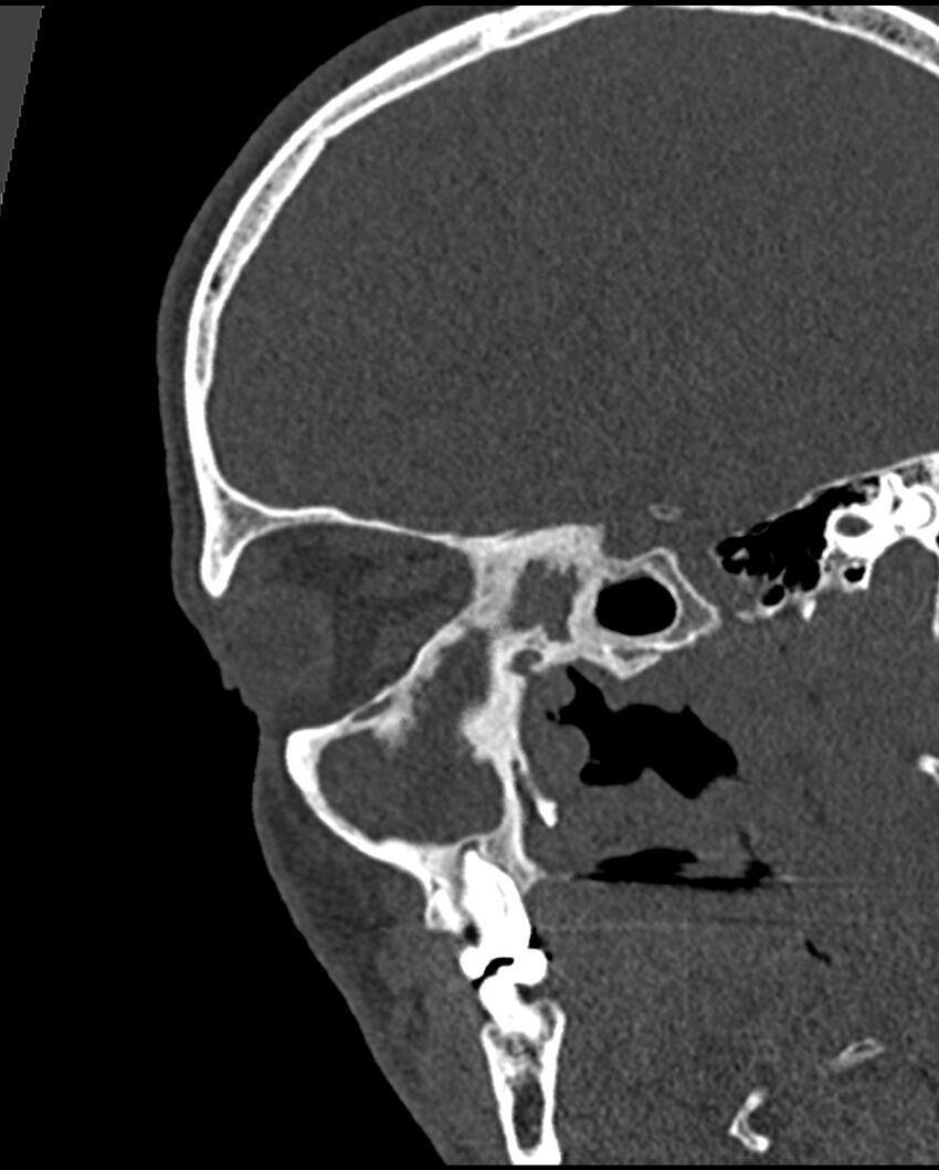 Chronic maxillary sinusitis caused by a foreign body (Radiopaedia 58521-65676 Sagittal bone window 39).jpg