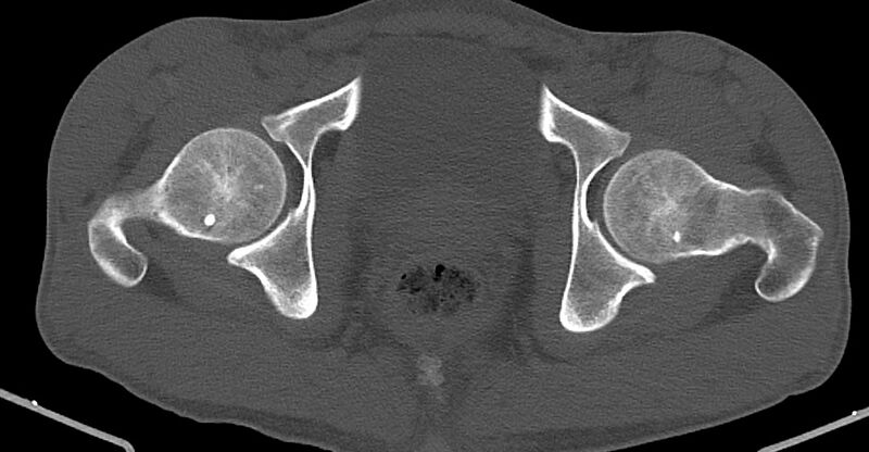 File:Chronic osteomyelitis (with sequestrum) (Radiopaedia 74813-85822 Axial non-contrast 40).jpg