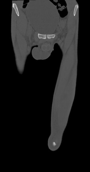 File:Chronic osteomyelitis (with sequestrum) (Radiopaedia 74813-85822 Coronal non-contrast 8).jpg