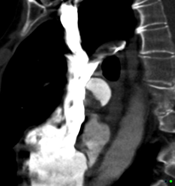 File:Chronic pulmonary embolism (Radiopaedia 17943-17702 Sagittal C+ CTPA 18).jpg