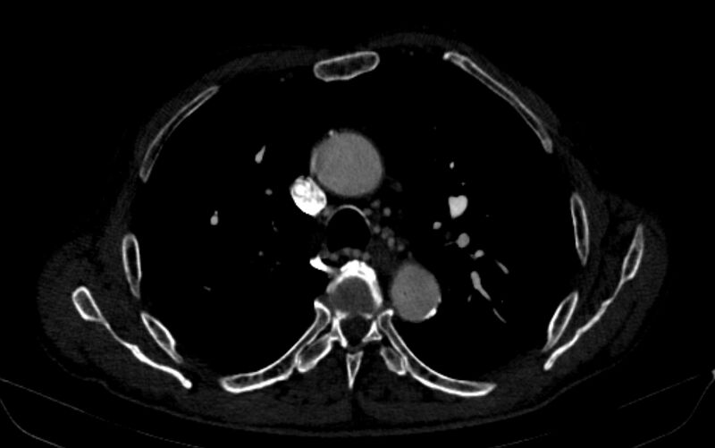 File:Chronic pulmonary embolism (Radiopaedia 91241-108843 B 66).jpg