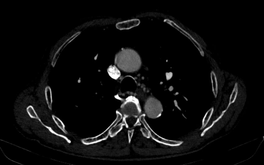Chronic pulmonary embolism (Radiopaedia 91241-108843 B 66).jpg