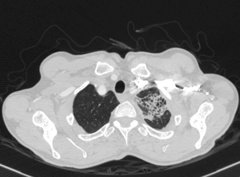 File:Chronic pulmonary embolism with bubbly consolidation (Radiopaedia 91248-108850 Axial lung window 12).jpg