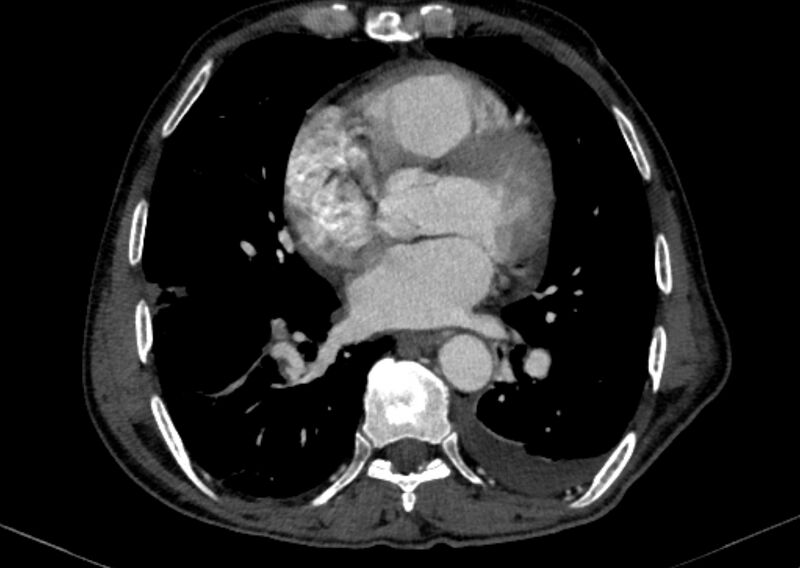 File:Chronic pulmonary embolism with bubbly consolidation (Radiopaedia 91248-108850 C+ arterial phase 93).jpg