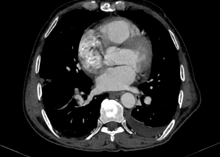 Chronic pulmonary embolism with bubbly consolidation (Radiopaedia 91248-108850 C+ arterial phase 93).jpg