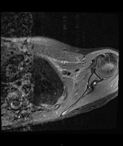 File:Chronic reactive multifocal osteomyelitis (CRMO) - clavicle (Radiopaedia 56406-63071 Axial T1 C+ fat sat 16).jpg