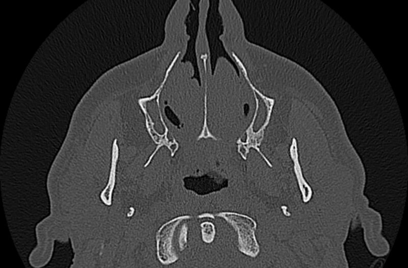 File:Chronic rhinosinusitis (Radiopaedia 65079-74075 Axial bone window 13).jpg