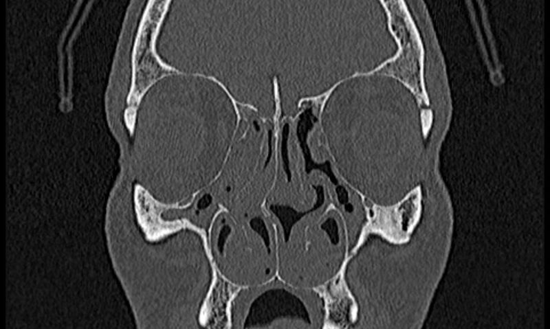 File:Chronic rhinosinusitis (Radiopaedia 65079-74075 Coronal bone window 28).jpg