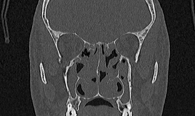 File:Chronic rhinosinusitis (Radiopaedia 65079-74075 Coronal bone window 45).jpg