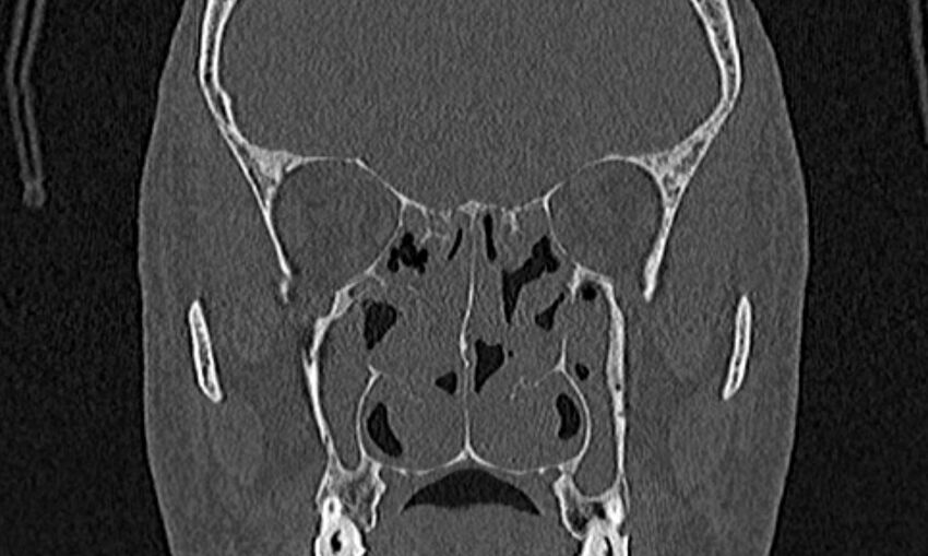 Chronic rhinosinusitis (Radiopaedia 65079-74075 Coronal bone window 45).jpg