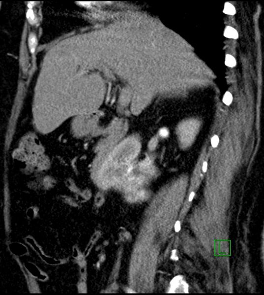 File:Clear cell renal cell carcinoma (Radiopaedia 85004-100537 D 39).jpg
