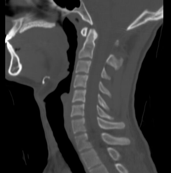 File:Cleft of the posterior arch of C1 mimicking fracture (Radiopaedia 40201-42721 Sagittal bone window 8).jpg
