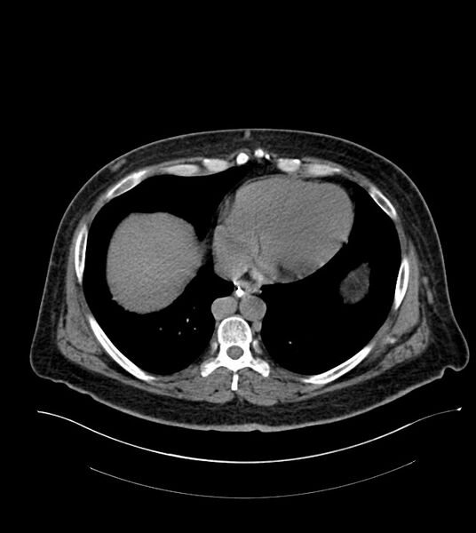 File:Closed-loop small bowel obstruction-internal hernia (Radiopaedia 78439-91096 Axial non-contrast 13).jpg