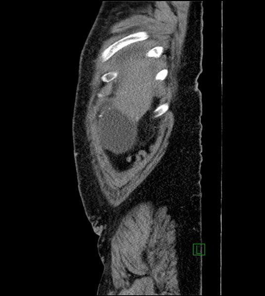 File:Closed-loop small bowel obstruction-internal hernia (Radiopaedia 78439-91096 C 129).jpg