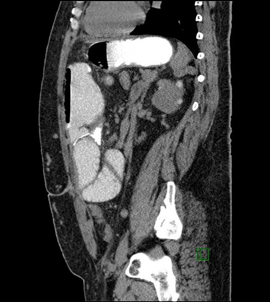 File:Closed-loop small bowel obstruction-internal hernia (Radiopaedia 78439-91096 C 58).jpg