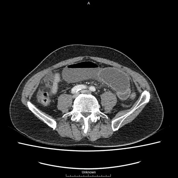 File:Closed loop bowel obstruction and ischemia (Radiopaedia 86959-103180 A 53).jpg