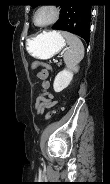 File:Closed loop small bowel obstruction - adhesions (Radiopaedia 59269-66611 C 29).jpg