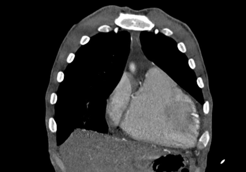 File:Coarctation of aorta with aortic valve stenosis (Radiopaedia 70463-80574 C 32).jpg