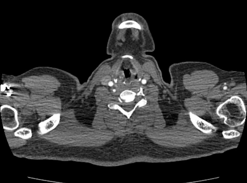 File:Coarctation of the aorta (Radiopaedia 53363-59343 A 2).jpg