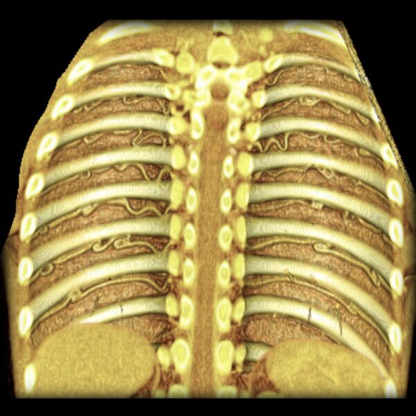File:Coarctation of the aorta (Radiopaedia 6279-7684 E 1).jpg
