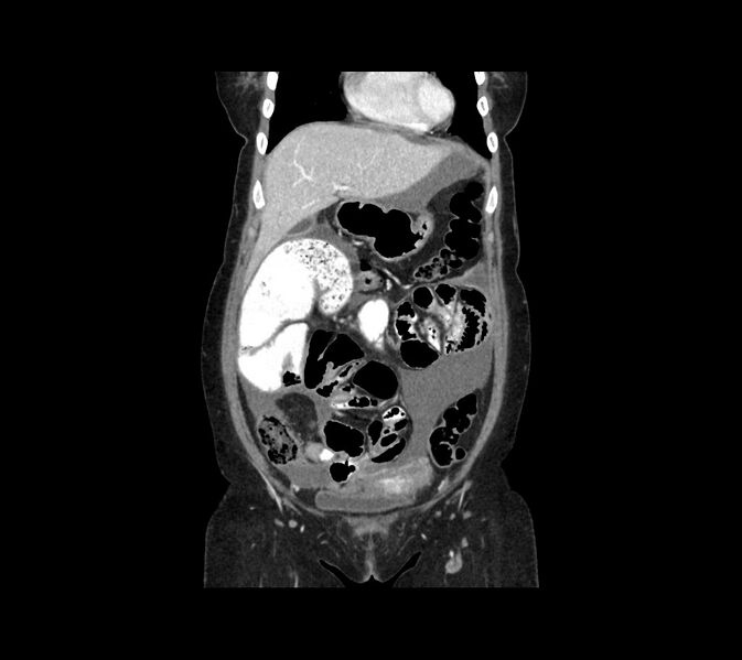 File:Cocoon abdomen with possible tubo-ovarian abscess (Radiopaedia 46235-50636 B 14).jpg